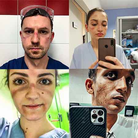 Sağlık çalışanlarının yüzlerindeki maske izi