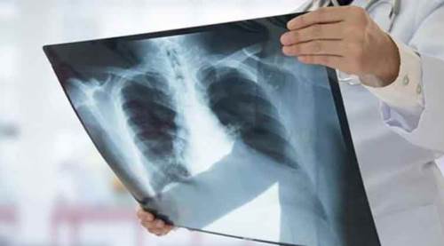 Uzmanından önemli uyarı: Akciğer kanserinin yüzde 90 sebebi...