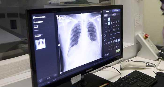 Kanser hastasına akciğer nakli yapıldı