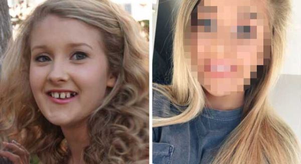 Diş teli taktırdıktan sonra adeta evrim geçirdiler!