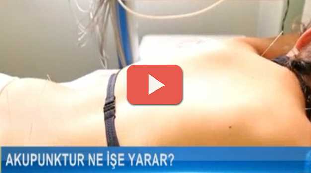Akapunktur ne işe yara nasıl uygulanır