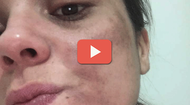 KİMYASAL PEELİNG MAĞDURU