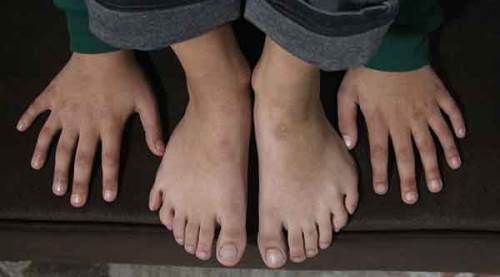 24 parmaklı çocuğa devletten özel ayakkabı