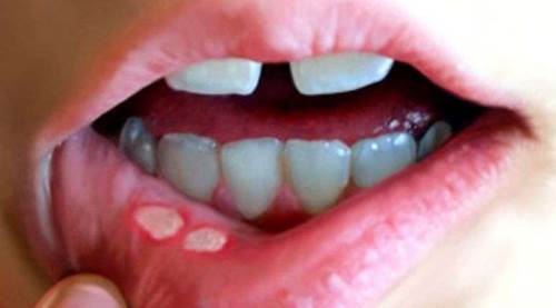 Aft Nedir, Neden Çıkar ve Nasıl Geçer? Ağız İçin İyi ve Kötü Besinler Açıklandı