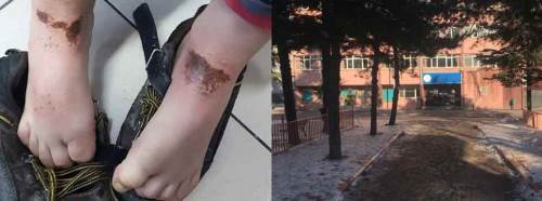 Afyonkarahisar'da kartopu oynarken vücutlarında yanık oluştu!