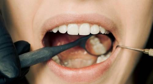 Ağızdaki Bakteri ve Mantarlar Pankreas Kanserine Mi Neden Oluyor?