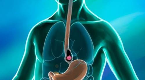 Akalazya Hastalığı: Nedenleri, Belirtileri, Teşhisi ve Tedavi Seçenekleri (Ameliyat Dahil)