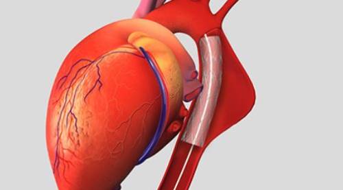 Aort yırtılması nedir, neden olur, belirtileri nelerdir?