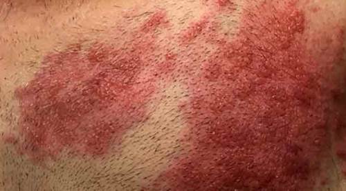 Bağışıklık sistemi zayıfladı, bu hastalık patladı