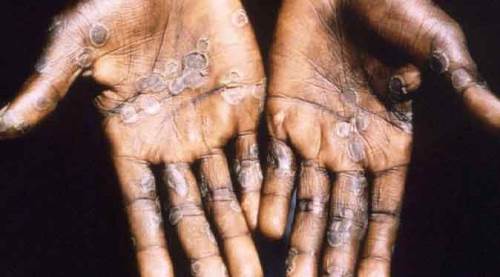 Bakan Koca açıkladı: Türkiye'de ilk maymun çiçeği vakası!