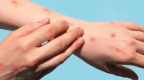 Bakan Koca'dan maymun çiçeği açıklaması: 5 kişide...