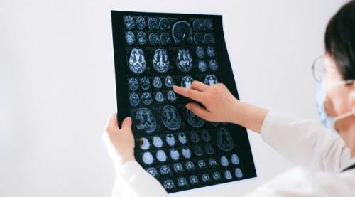 Beyin Yaşlanmasını Hızlandıran Gizli Tehlike: Vitamin Eksiklikleri ve Zihinsel Sağlığınız