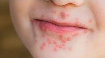 Boca Virus: Yeni Bir Salgın mı? Belirtileri, Yayılımı ve Korunma Yolları (2026)