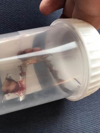 Boğazı Acıyan Ve Nefes Almakta Zorluk Çeken Kadının Boğazından Bakın Ne Çıktı?
