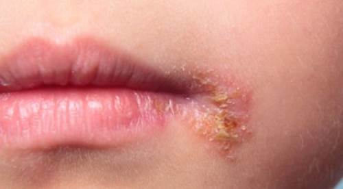 Çocuğumda Sürekli Uçuk Çıkıyor: Nedenleri, Çözümleri ve Önleme Yolları