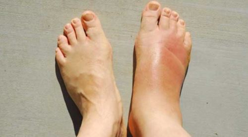 Çocuklarda el ayak ağız hastalığına dikkat 