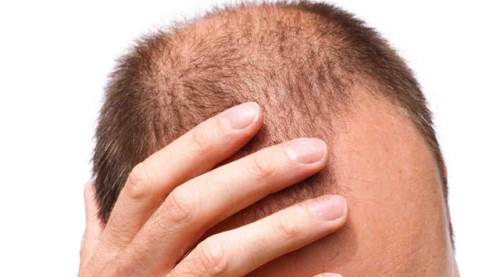 Demir eksikliği saçları döküyor