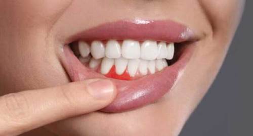 Diş Apsesi Hakkındaki Yanlış Bilgileri Unutun!