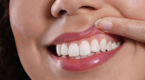 Diş Eti Büyümesi: Löseminin Belirtisi Olabilir!