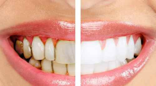 Diş taşlarını yok eden doğal çözüm