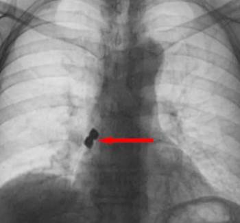 Diş Tedavisinde Hastanın Başına Geleni Duyanlar Şaştı Kaldı
