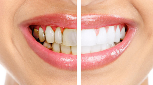 DİŞLERİMİZ NEDEN SARARIR?