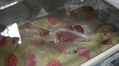  Doktorları bile şaşırttı: Sadece 310 gram doğdu!