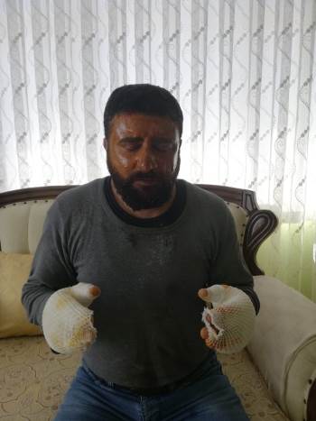 Elektrik Çarpması Sonucu Ağır Yaralanan Vatandaş Taburcu Oldu
