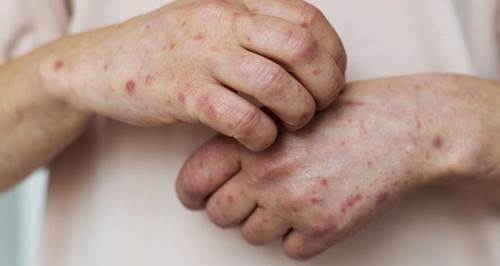 Eskişehir'de aktarların "uyuz" mesaisi başladı! O ikisi yok satıyor... 