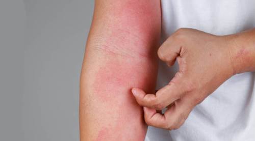 Eskişehir'de de arttı: Uyuz hastalığı belirtileri neler, uyuz tedavisi nasıl yapılır?