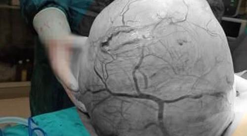 Eskişehir'deki o hastanede ilginç olay: Kilo aldığını sandı ama...