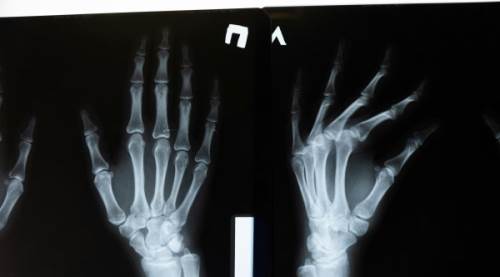 Fraktür Nedir? Tanım, Türleri ve Tedavi Yöntemleri