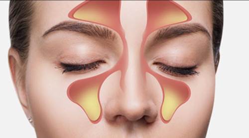 Geçmeyen Burun Akıntısı Alarm Veriyor: Üç Haftayı Aşarsa Hayati Tehlike Olabilir