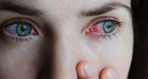 Gözleriniz kızarıp kaşınıyor mu? Doktora gitmek için acele edin!