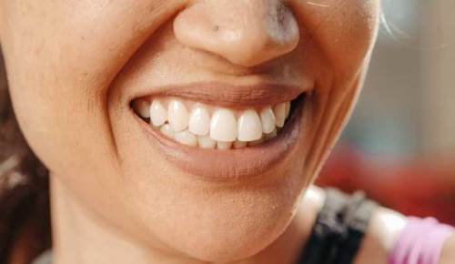 Gülüş estetiği ve tasarımı nedir, neden bu kadar popüler? İşte detaylar...