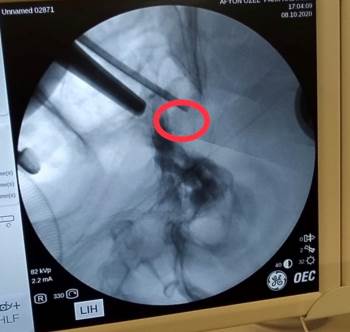 Hastanın Beyindeki Tümörü Burun Deliğinden Çıkardılar
