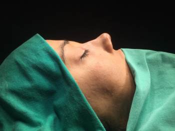 Kaburga Kıkırdağından Yeni Burun Ucu
