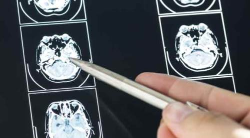 Kadınlarda 3 kat fazla görülüyor, tedavisi ise...