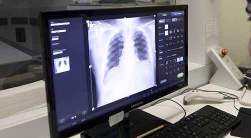 Kanser hastasına akciğer nakli yapıldı