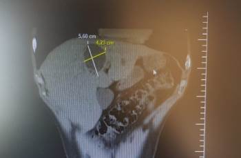 Karaciğerindeki Kistten 3 Saatlik Operasyonla Kurtuldu
