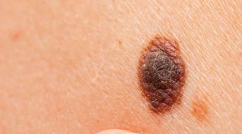 Karsinom Ne Demek? Vücudun Alarm Sinyali Olan Kanser Türünü Tanıyın