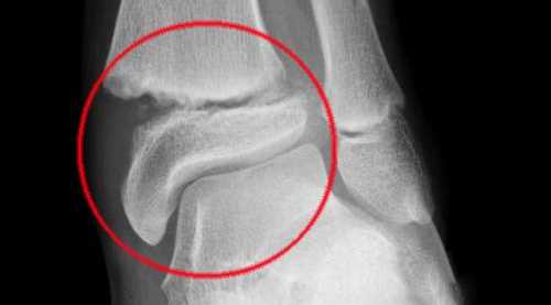 Kemik kırıklarına "Bor"lu çözüm