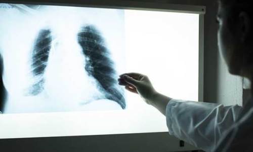 KOAH nasıl bir hastalık, belirtileri nelerdir? Uzmanı uyarılarda bulundu