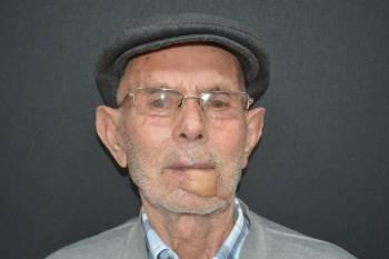 Kol Ve Bacağından Alınan Dokularla Yeni Dudağı Oluşturuldu
