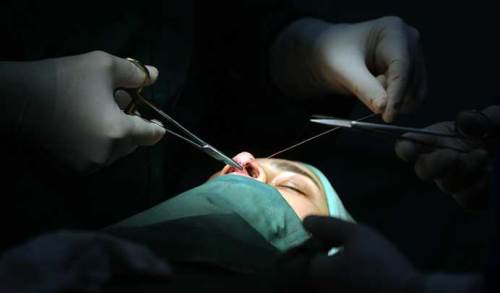 Komplikasyon ne demek? Ameliyat komplikasyonu nedir?