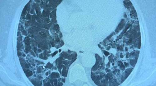 Koronavirüs geçirdiyseniz bu belirtilere dikkat: İyileşmemiş olabilirsiniz!