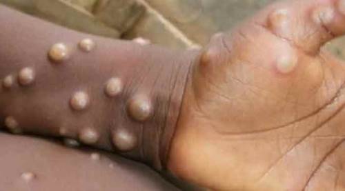 Koronavirüsten sonra 'maymun çiçeği' virüsü alarmı: Türkiye'de...