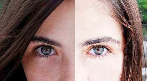 Lekesiz bir cilt hayal değil