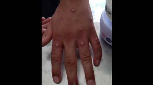 Maymun çiçeği şüphesi korkuttu! Test sonucu bekleniyor...