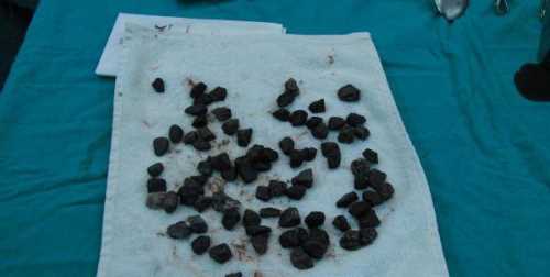 MİDESİNDEN 190 GRAM TAŞ ÇIKTI
